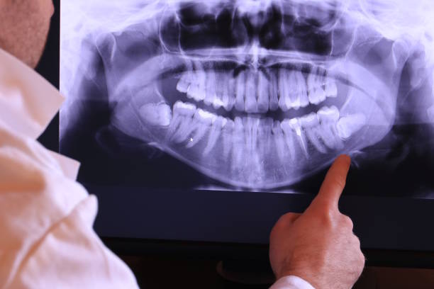 Best Emergency Dentist for Lost Fillings or Crowns in Monroe, WA